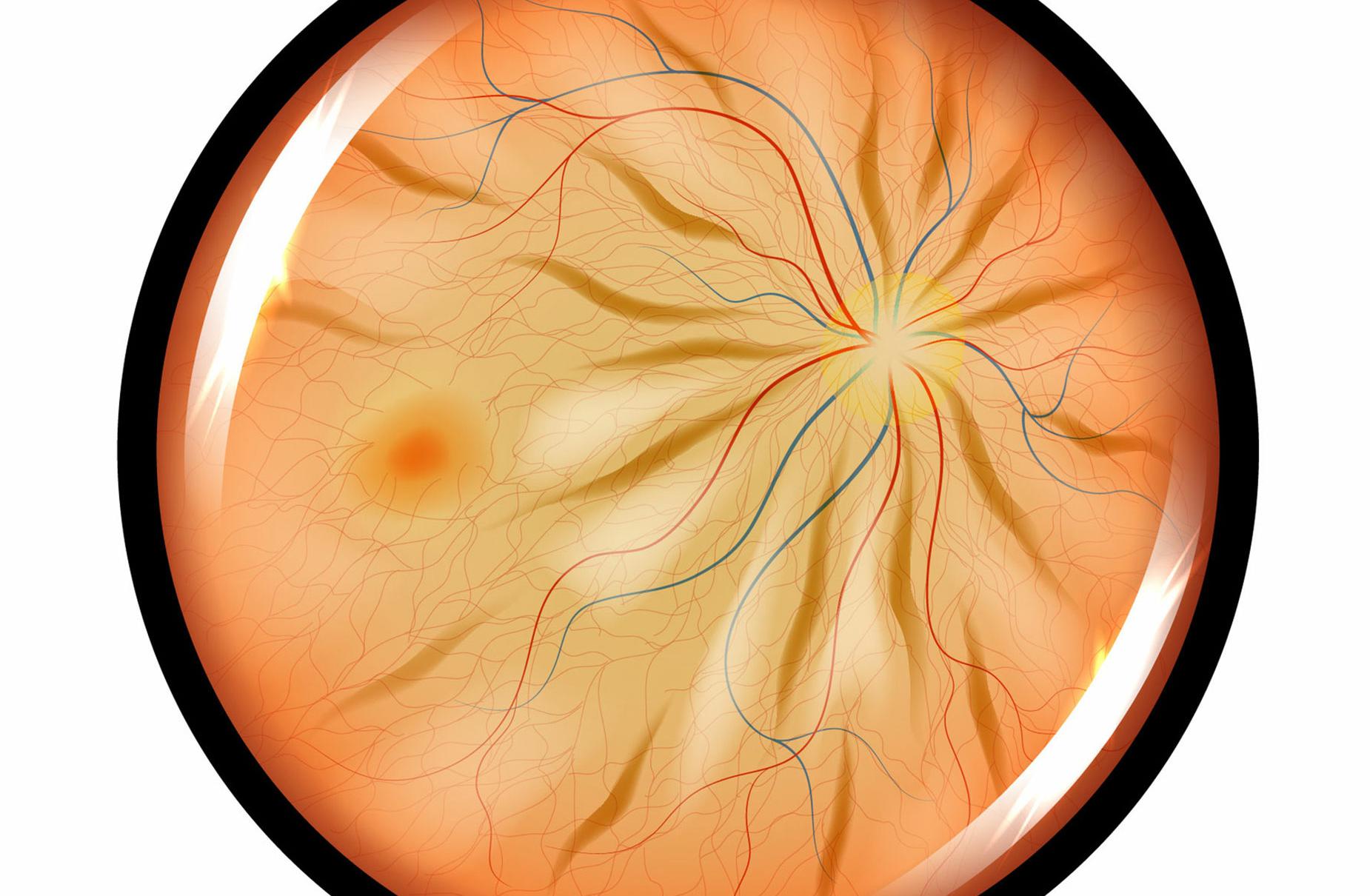 membrane epiretinienne