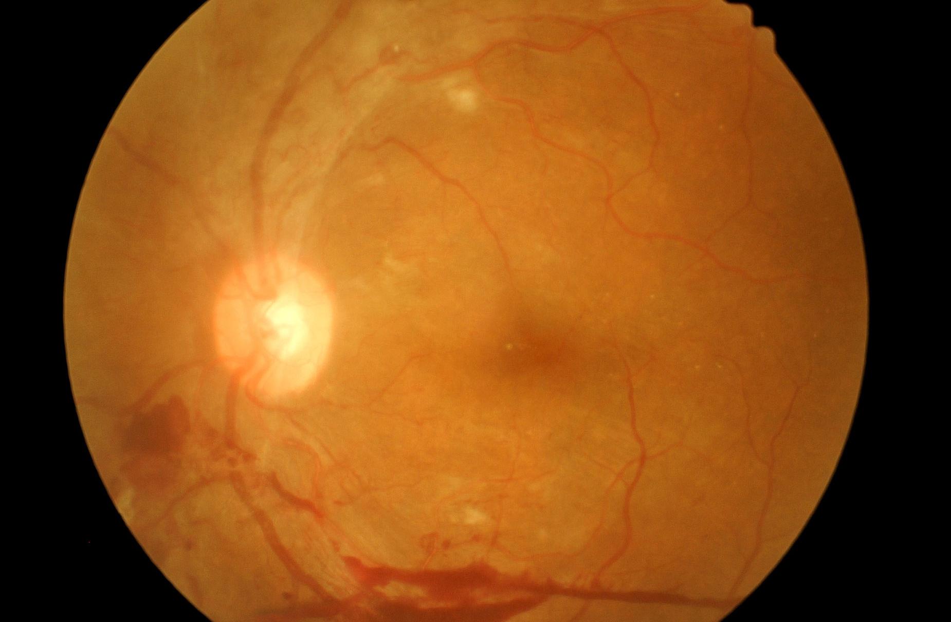 Occlusions vasculaires rétiniennes